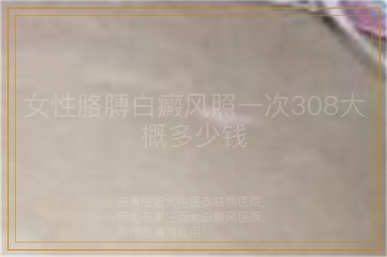女性胳膊白癜风照一次308大概多少钱