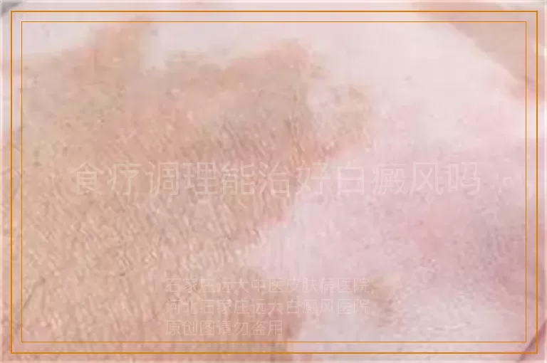 食疗调理能治好白癜风吗