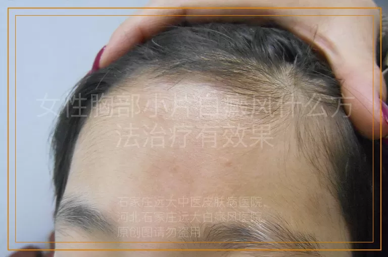 女性胸部小片白癜风什么方法治疗有效果
