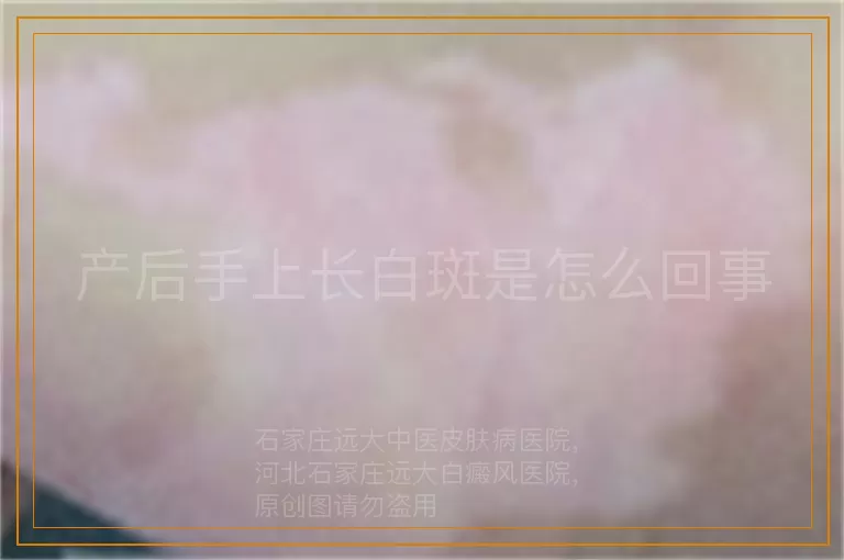 产后手上长白斑是怎么回事