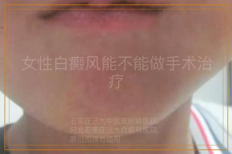 女性白癜风能不能做手术治疗