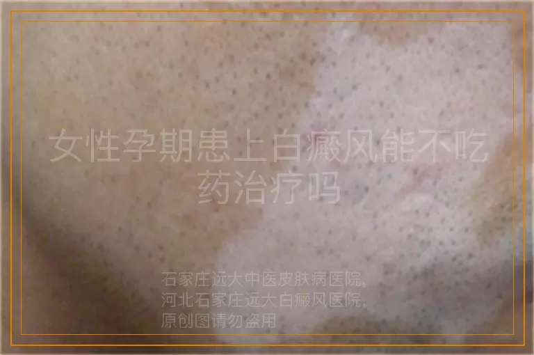 女性孕期患上白癜风能不吃药治疗吗