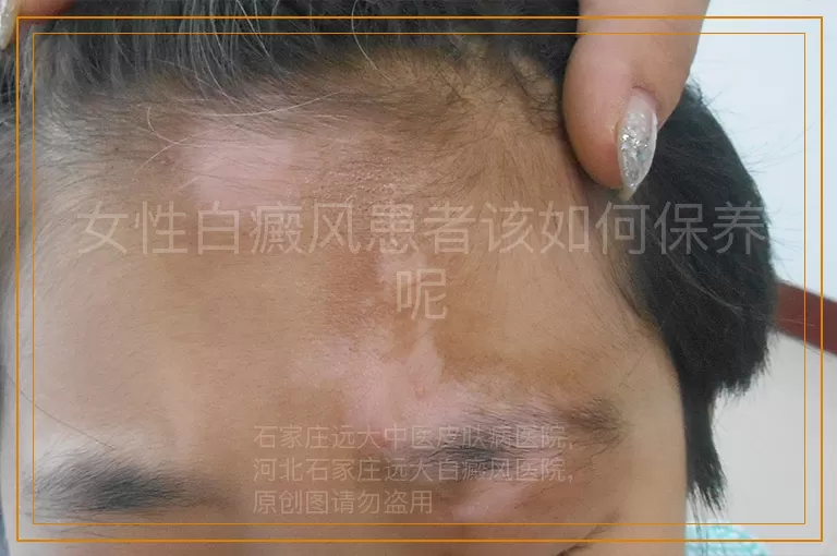 女性白癜风患者该如何保养呢
