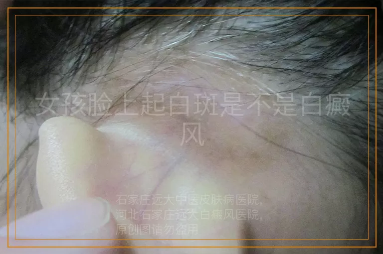 女孩脸上起白斑是不是白癜风