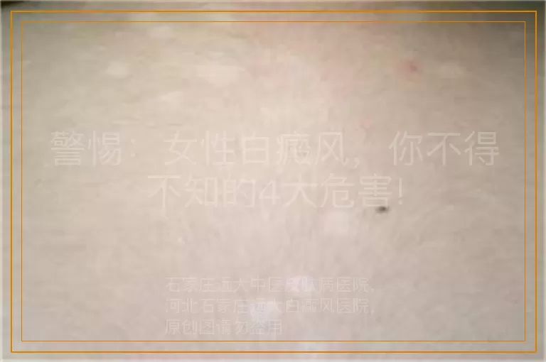 警惕：女性白癜风，你不得不知的4大危害!