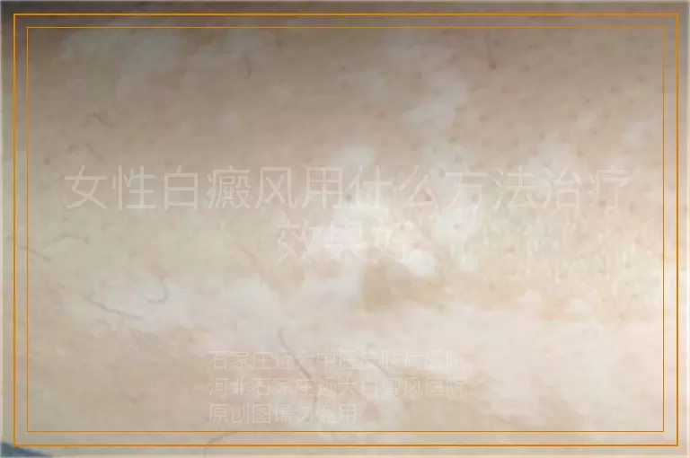 女性白癜风用什么方法治疗效果好