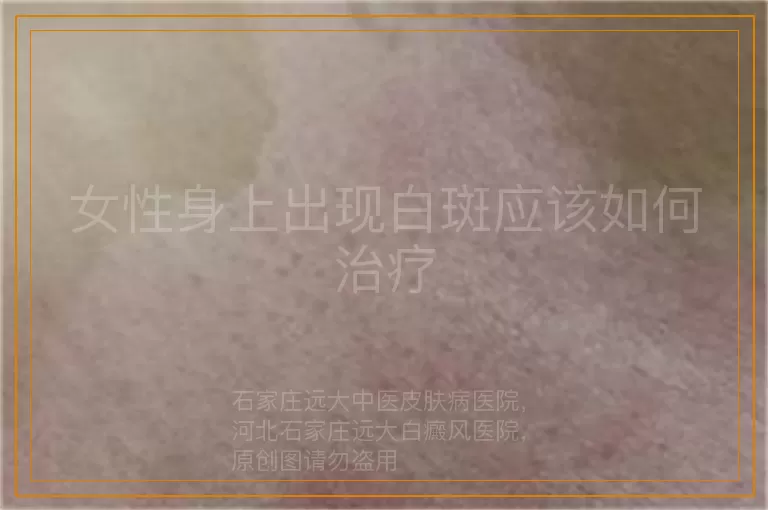 女性身上出现白斑应该如何治疗