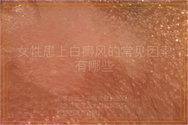 女性患上白癜风的常见因素有哪些