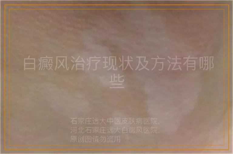 白癜风治疗现状及方法有哪些