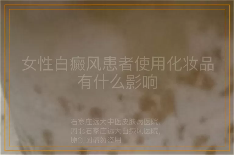 女性白癜风患者使用化妆品有什么影响