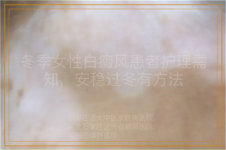 冬季女性白癜风患者护理需知，安稳过冬有方法