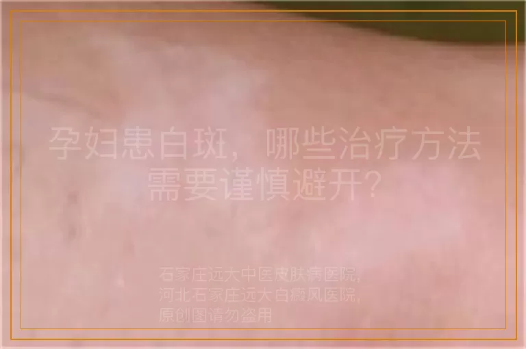 孕妇患白斑，哪些治疗方法需要谨慎避开？