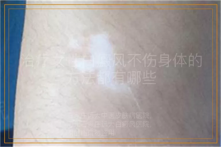 治疗女性白癜风不伤身体的方法都有哪些
