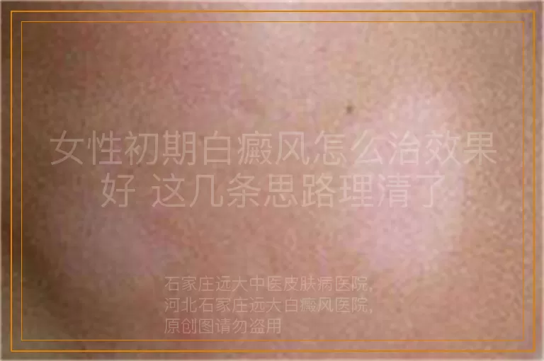 女性初期白癜风怎么治效果好 这几条思路理清了