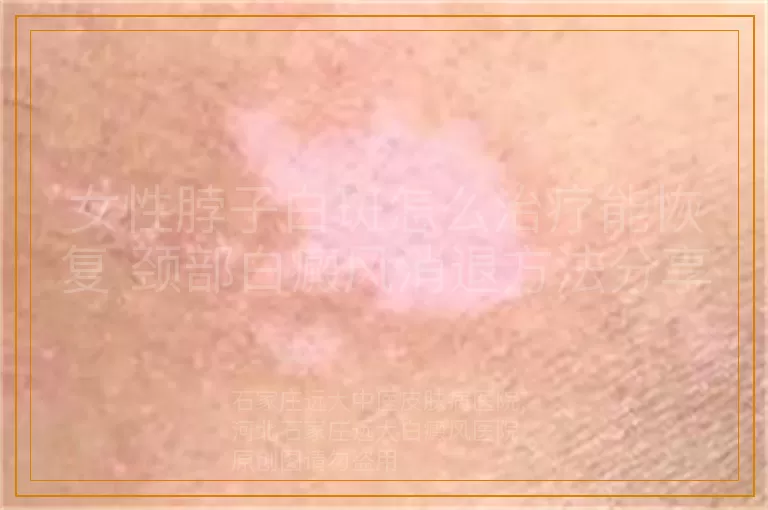 女性脖子白斑怎么治疗能恢复 颈部白癜风消退方法分享