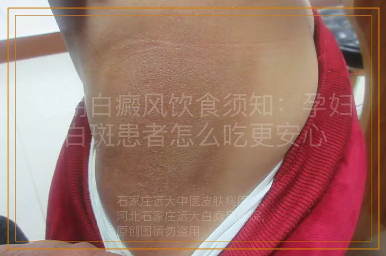 孕期白癜风饮食须知：孕妇白斑患者怎么吃更安心