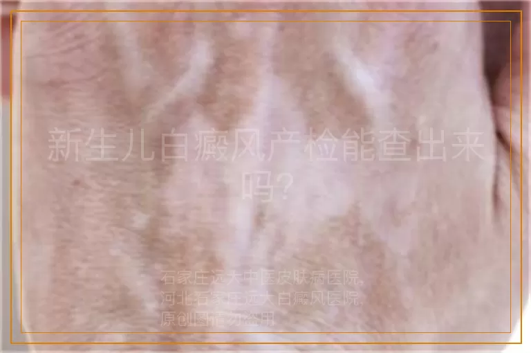新生儿白癜风产检能查出来吗？