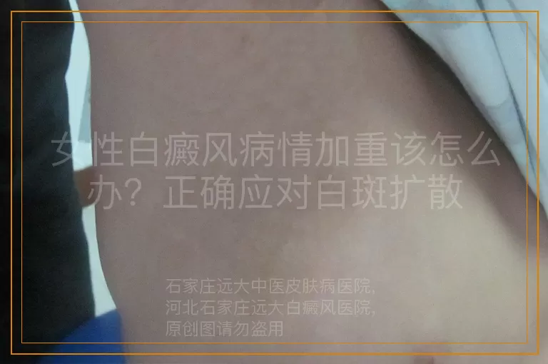 女性白癜风病情加重该怎么办？正确应对白斑扩散