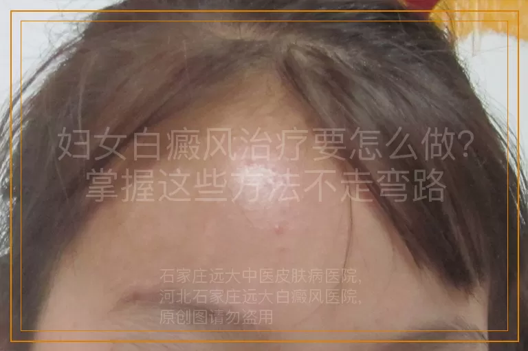 妇女白癜风治疗要怎么做？掌握这些方法不走弯路