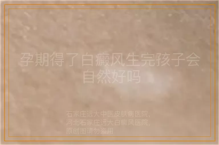 孕期得了白癜风生完孩子会自然好吗