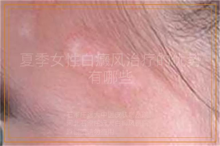 夏季女性白癜风治疗的优势有哪些