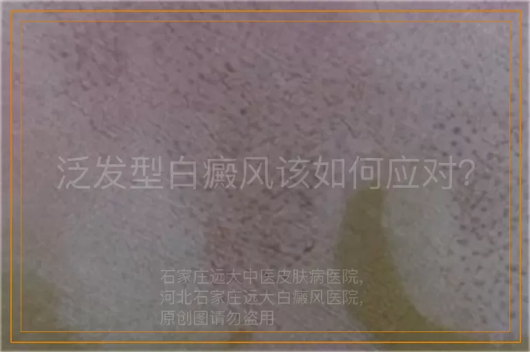 泛发型白癜风该如何应对？