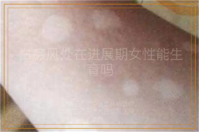 白癜风处在进展期女性能生育吗