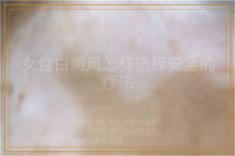 女性白癜风怎样选择安全的疗法