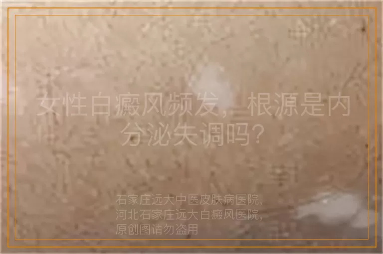 女性白癜风频发，根源是内分泌失调吗？