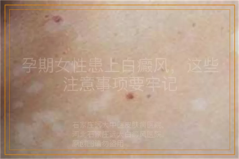 孕期女性患上白癜风，这些注意事项要牢记