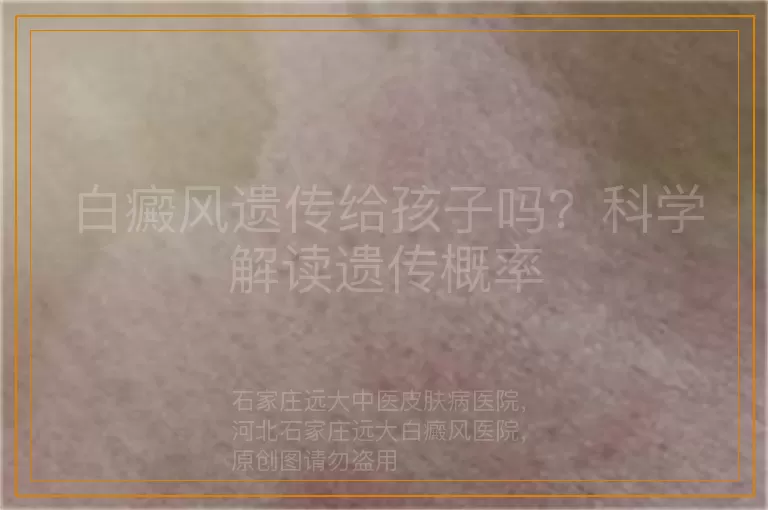 白癜风遗传给孩子吗？科学解读遗传概率