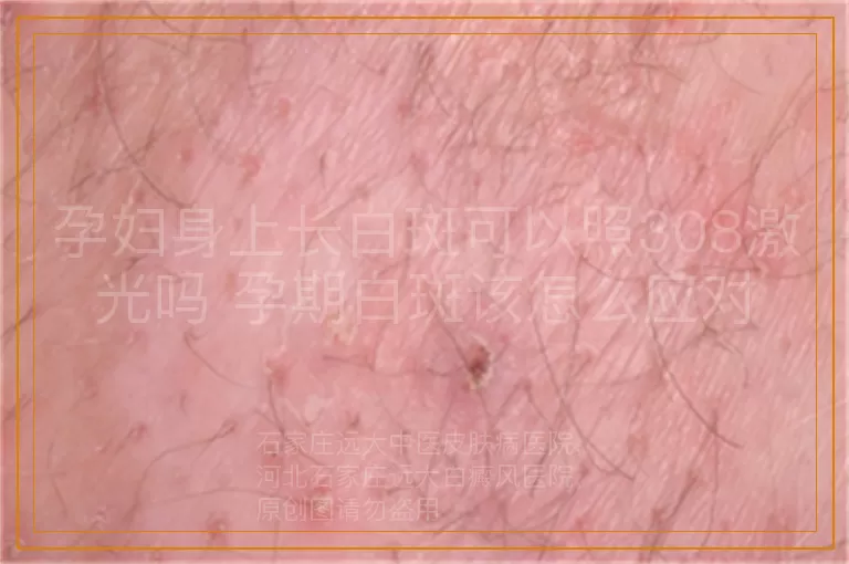 孕妇身上长白斑可以照308激光吗 孕期白斑该怎么应对