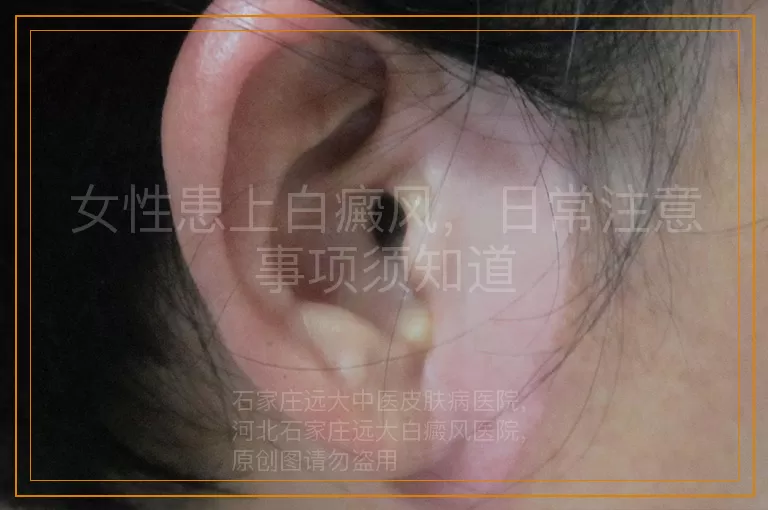 女性患上白癜风，日常注意事项须知道