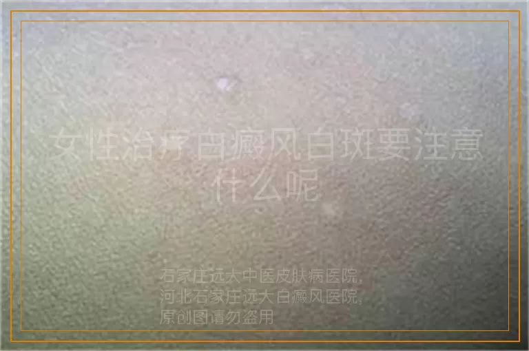 女性治疗白癜风白斑要注意什么呢