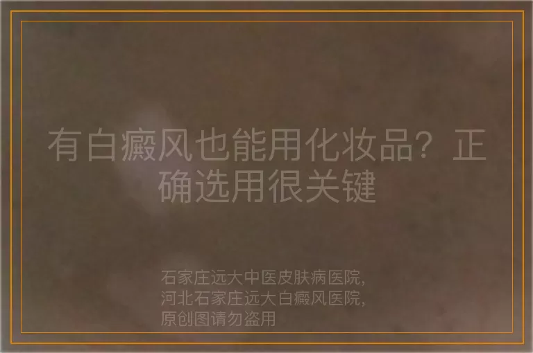 有白癜风也能用化妆品？正确选用很关键