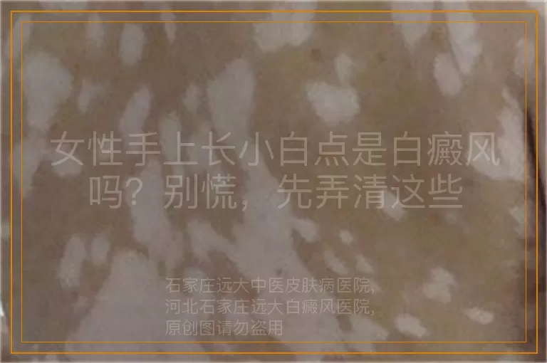 女性手上长小白点是白癜风吗？别慌，先弄清这些