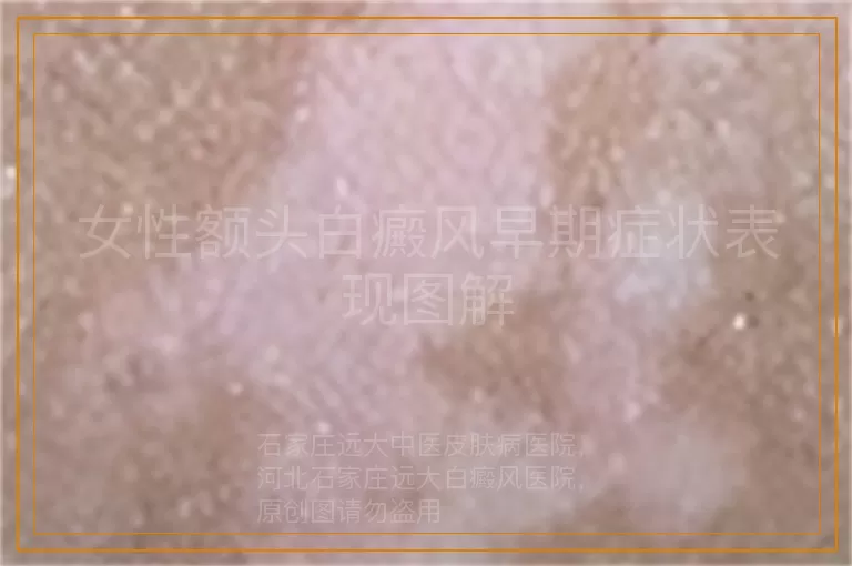 女性额头白癜风早期症状表现图解