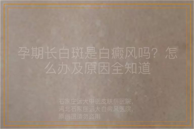 孕期长白斑是白癜风吗？怎么办及原因全知道