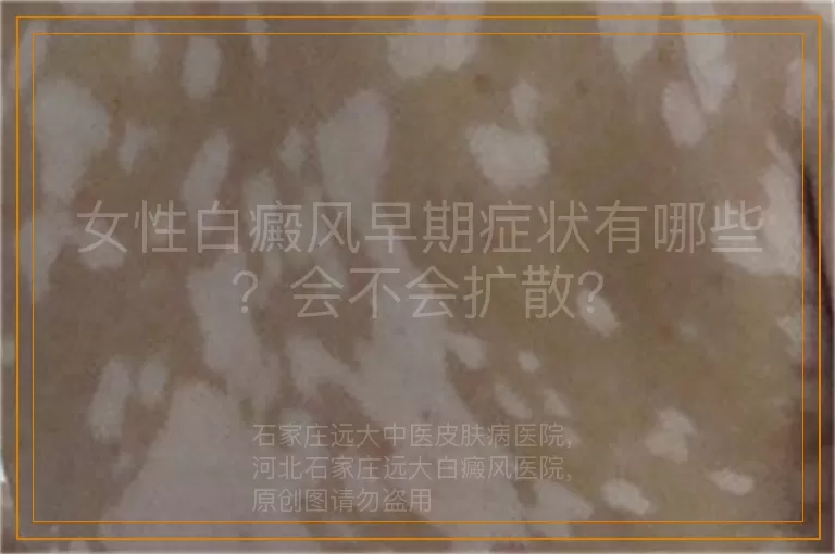女性白癜风早期症状有哪些？会不会扩散？