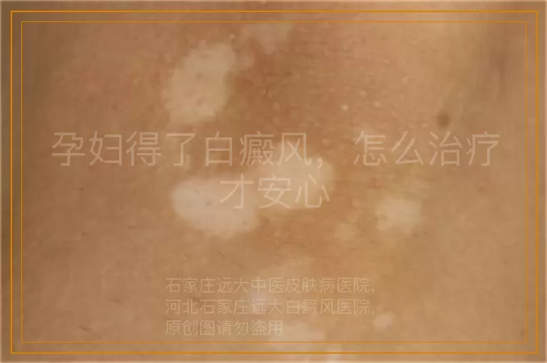 孕妇得了白癜风，怎么治疗才安心