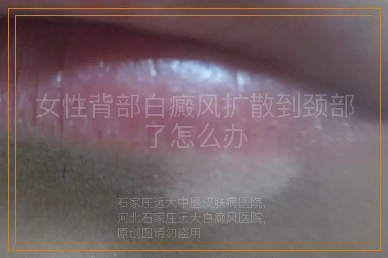 女性背部白癜风扩散到颈部了怎么办