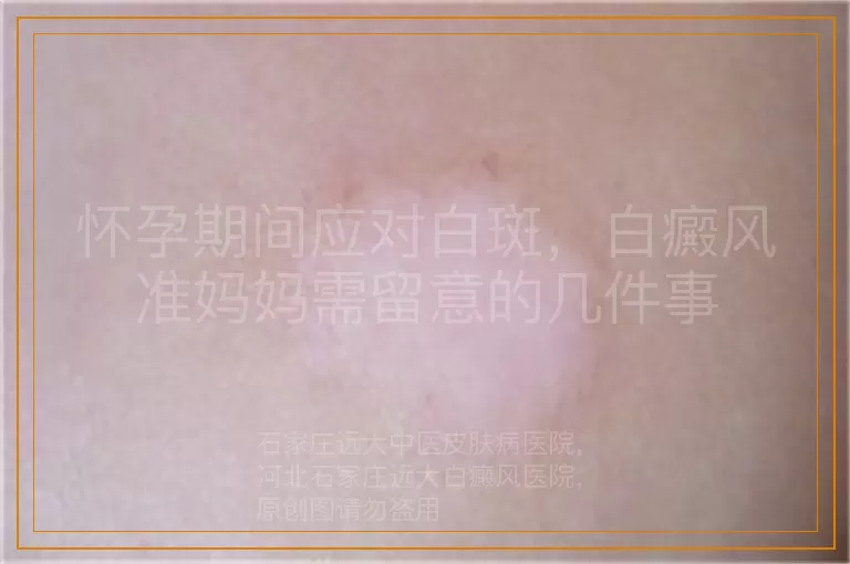 怀孕期间应对白斑，白癜风准妈妈需留意的几件事