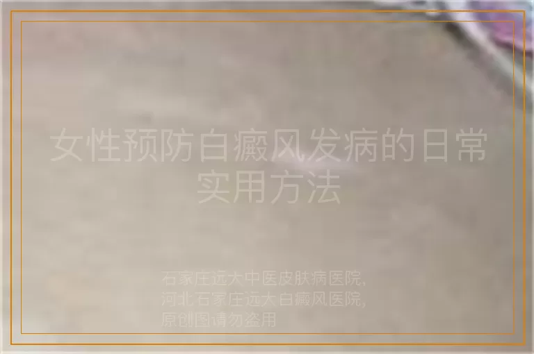 女性预防白癜风发病的日常实用方法