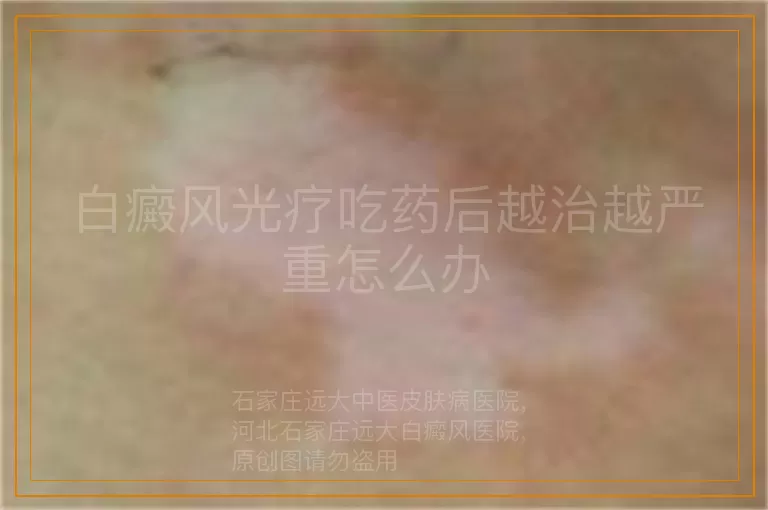 白癜风光疗吃药后越治越严重怎么办