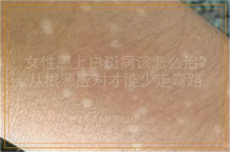女性患上白斑病该怎么治？从根源应对才能少走弯路