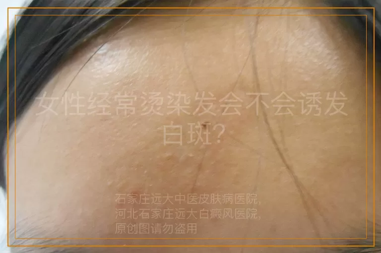 女性经常烫染发会不会诱发白斑？
