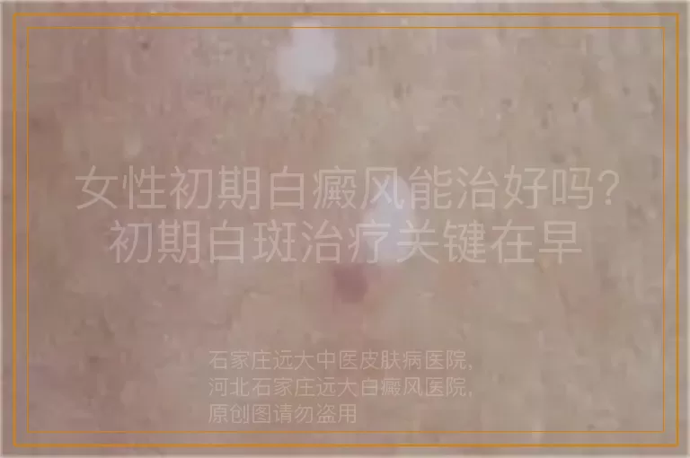 女性初期白癜风能治好吗？初期白斑治疗关键在早