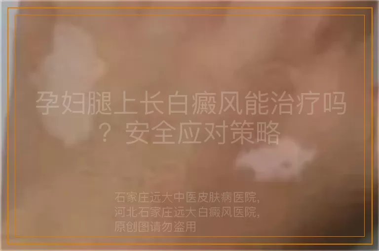 孕妇腿上长白癜风能治疗吗？安全应对策略