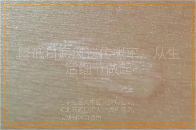 降低白癜风遗传概率，从生活细节做起