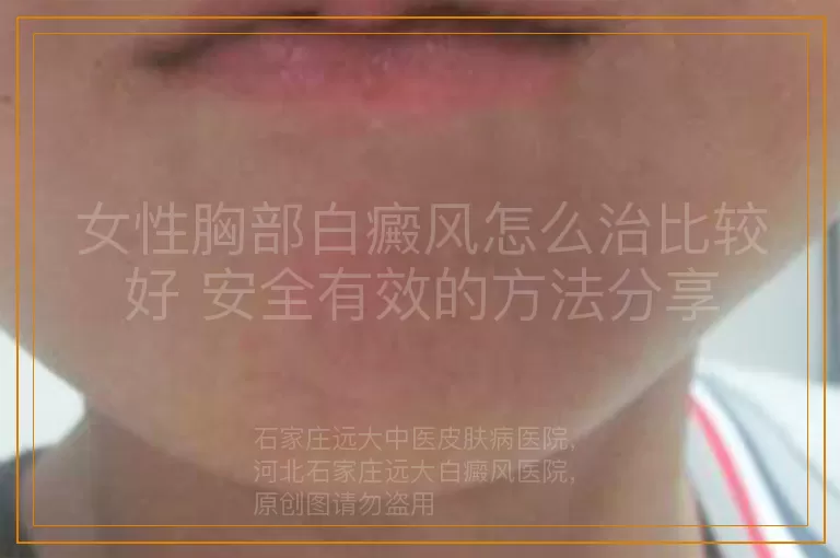 女性胸部白癜风怎么治比较好 安全有效的方法分享